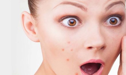 Acne (Causes and treatment)